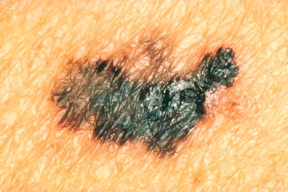 Melanom mit mehreren Farben – NCI-Beispielbild zum ABCDE-Merkmal C (Farbe)